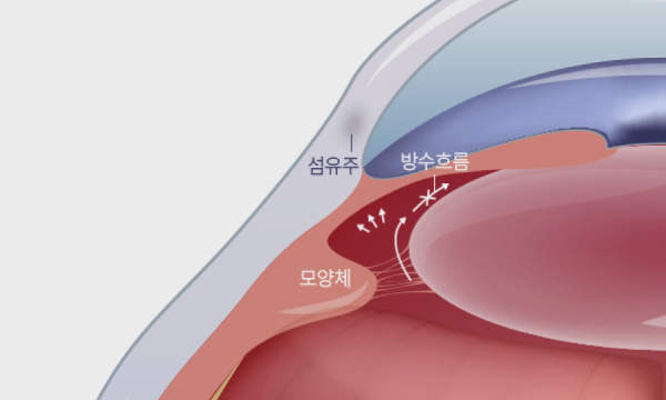 급성(폐쇄각) 녹내장