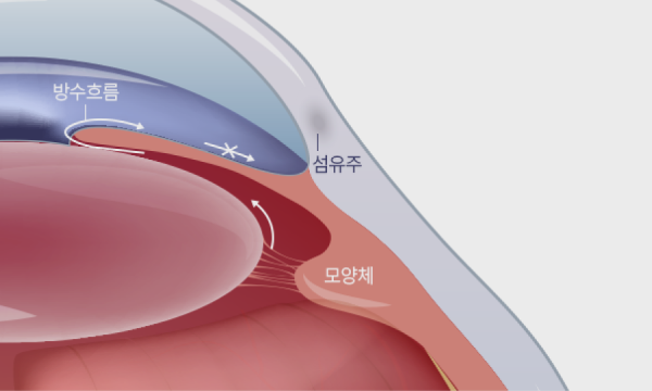 만성(개방각) 녹내장