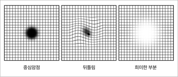 중심암점, 뒤틀림, 희미한 부분