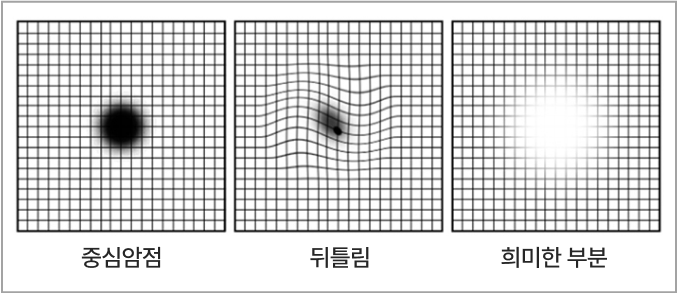 중심암점, 뒤틀림, 희미한 부분