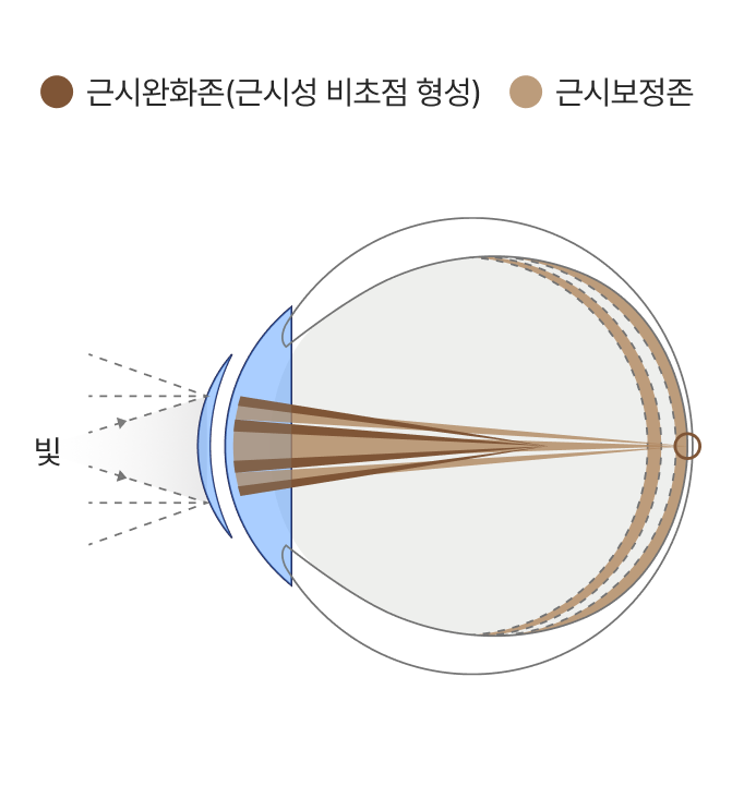 근시완화존(근시성 비초점 형성), 근시보정존