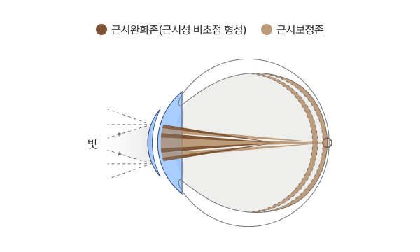 근시완화존(근시성 비초점 형성), 근시보정존